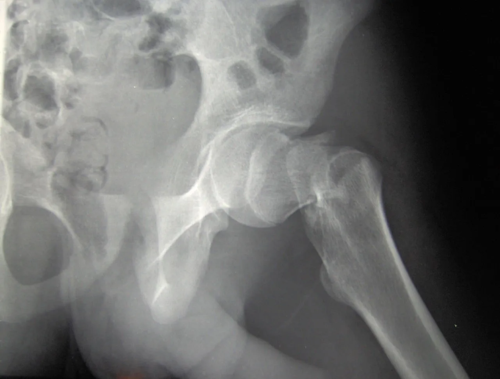 Hip Fractures